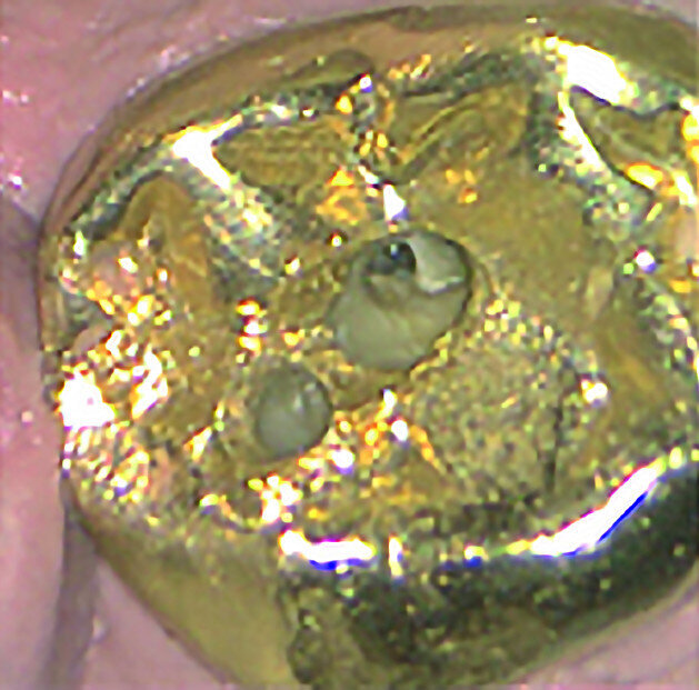 Figs. 12a–d : Depuis la gauche : Cas de l’auteur : dent
37 présentant une fracture radiculaire ; cette dent
montée dans un modèle en plâtre-pierre après extraction,
avec impression du guide de forage CTGEA
monté et du premier foret en place ; les deux
petits orifices d’accès préparés au moyen du guide
de forage ; et la radiographie postopératoire montrant
l’adaptation des cônes dans les canaux après leur négociation et leur mise en forme.