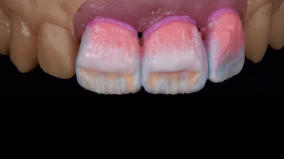 Fig. 9_Build-up dentine ed effetti.