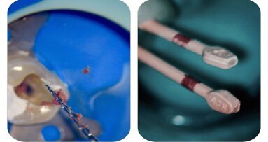 A permanent attempt to make endodontics easy and clear