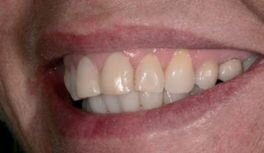 Afbeelding 1-4: Mondfoto’s en intraorale scans. In een eerste bezoek werd de wens met de patiënt besproken en werd er een aantal mondfoto’s gemaakt.