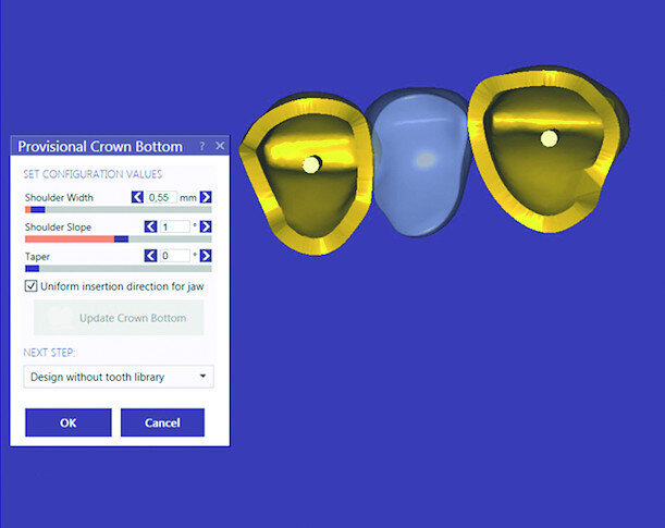 Fig. 9b: Positioning of the insertion angle of the future preparation (a). Adjustment of the thickness of the walls of the temporary bridge (b).
