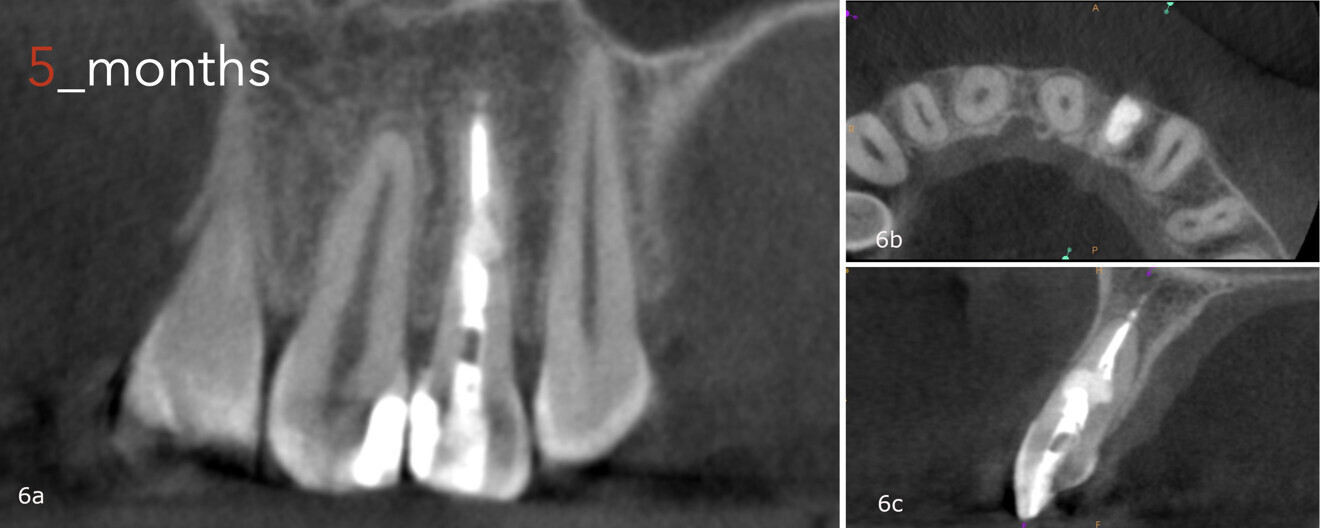 Figs. 6a–c: CBCT scan taken five months after the treatment, showing the healed lesion.
