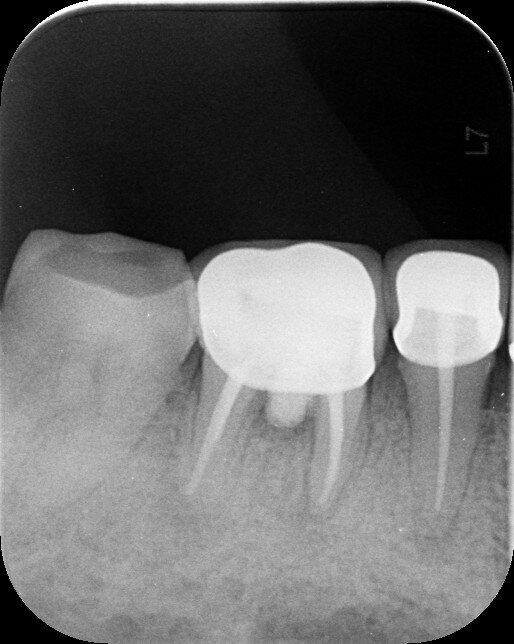 Fig. 7b: Fourteen-month follow-up (May 2020).