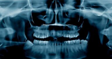 Osteonecrosi: una malattia che fa paura