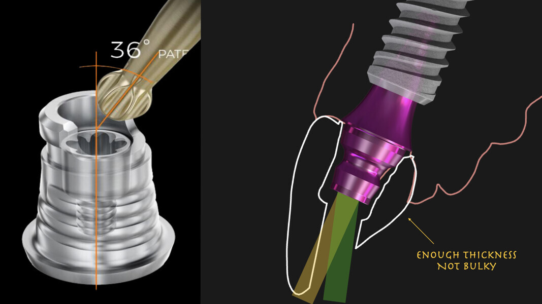 Fig. 12: Utilising multiSHIFT36° to avoid having a bulky restoration in the palatal aspect.