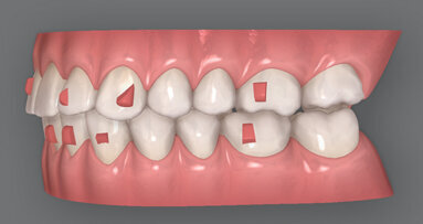 Důležitost plánování léčby a spolupráce pacienta u ortodontické techniky fóliových aparátů