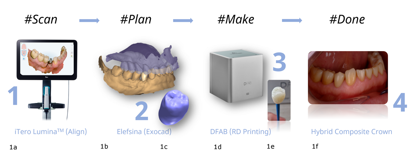 Figs. 1a–f: Overview of the digital workflow for fabrication of a 3D-printed hybrid composite restoration. Intra-oral scan with iTero Lumina (Align Technology; a). CAD modelling with DentalCAD (exocad), producing an STL file of the design for the definitive restoration (b & c). High-precision 3D printing of the restoration with Dfab using Irix Max (d & e), followed by post-polymerisation, polishing and delivery of the restoration to the patient (f).