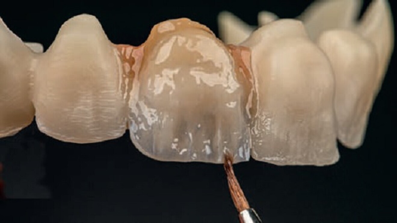 Application of CERABIEN MiLai internal stains to a zirconia bridge. (Image: Ioulianos Moustakis)