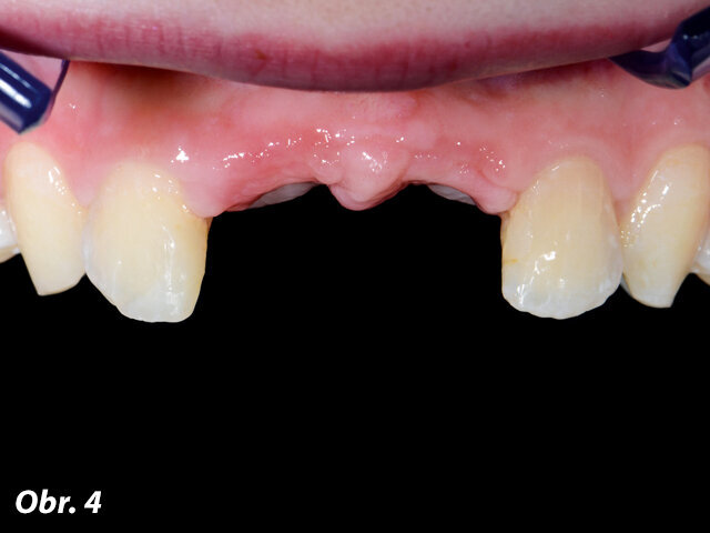 Obr. 4: Situace při první návštěvě mladé pacientky v soukromé zubní ordinaci na LMU v Mnichově