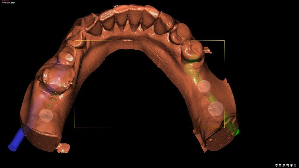 Precyzja zabiegów implantologicznych – badania in vitro z wykorzystaniem druku 3D – cz. 1