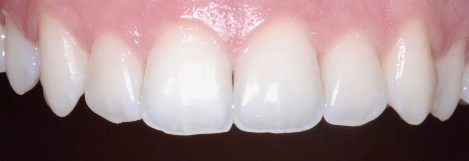 Fig. 36: Close-up intra-oral maxillary frontal view after treatment.