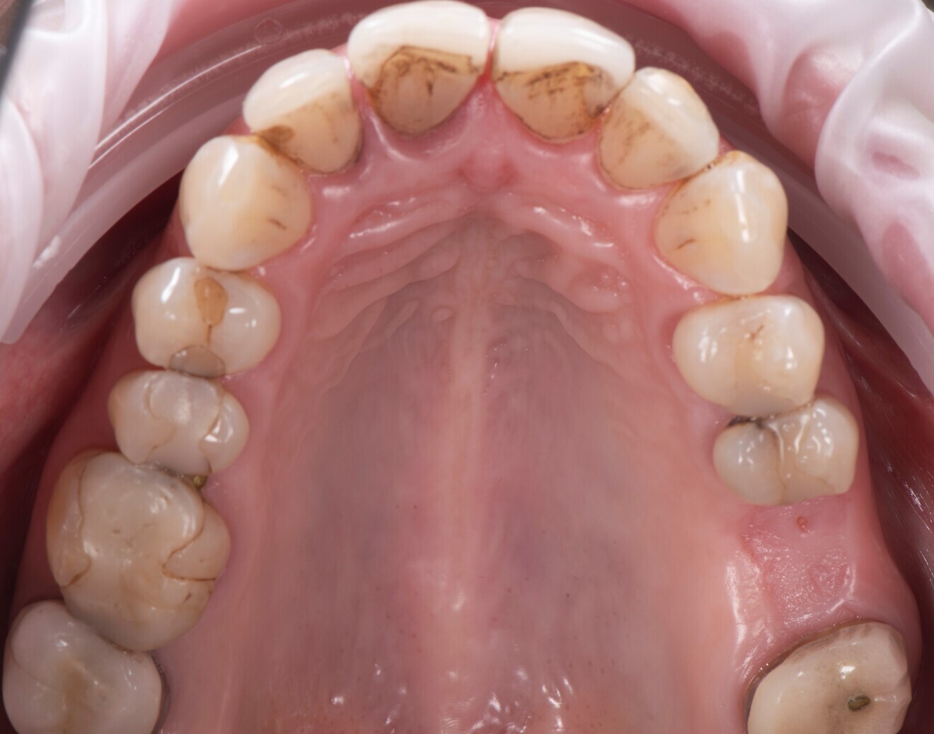Fig. 1a: Pre-op situation. Occlusal view of the edentulous first left molar site of the maxilla. 