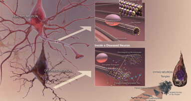 Alzheimer’s, cognitive decline linked to periodontal disease