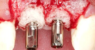 Augmentation: Specialist presents bone ring technique