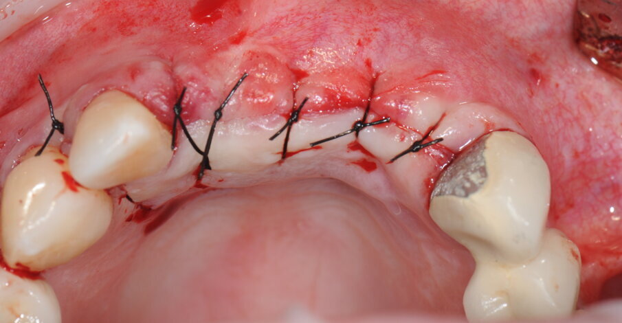Fig. 19 - Sutura del lembo.