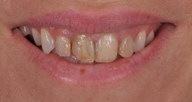 BEST.FIT: A hybrid technique for efficient and aesthetic restoration of anterior teeth