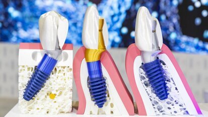 MegaGen introduces the fourth innovation in implantology