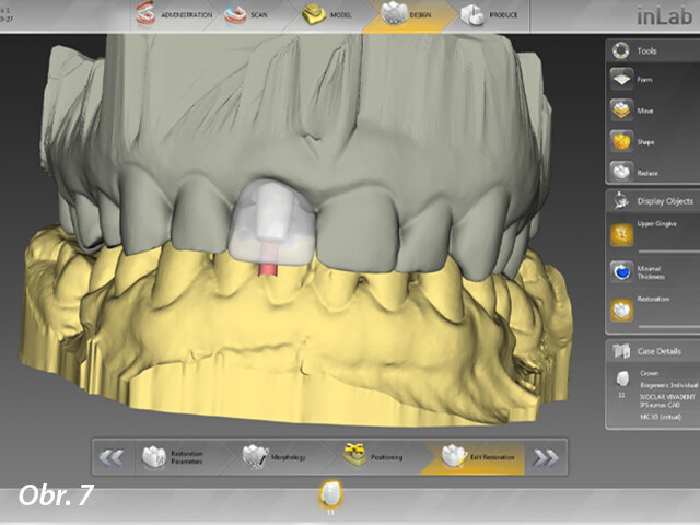 Plánování tvaru a velikosti budoucí CSD/CAM e.max korunky v programu In Lab 16 na základě obdrženého souboru Core File.