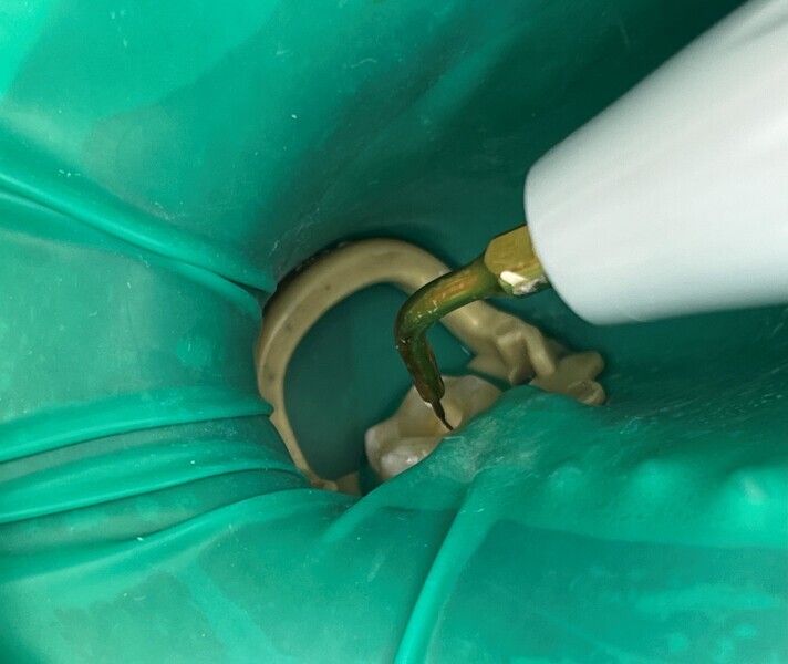 Fig. 3: Ultrasonically activated irrigation.