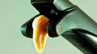 Laserowe obrazowanie i diagnostyka próchnicy w technologii NIDIFOTI