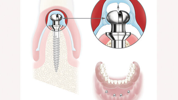 Atlas Denture Comfort secures new or existing dentures