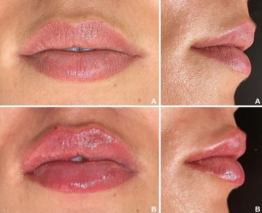 Patiënt uit de groep met dikkere lippen (a) voor lipvergroting en (b) tien dagen na lipaugmentatie  (foto: De Queiroz Hernandez et al., licensed under CC BY 4.0)