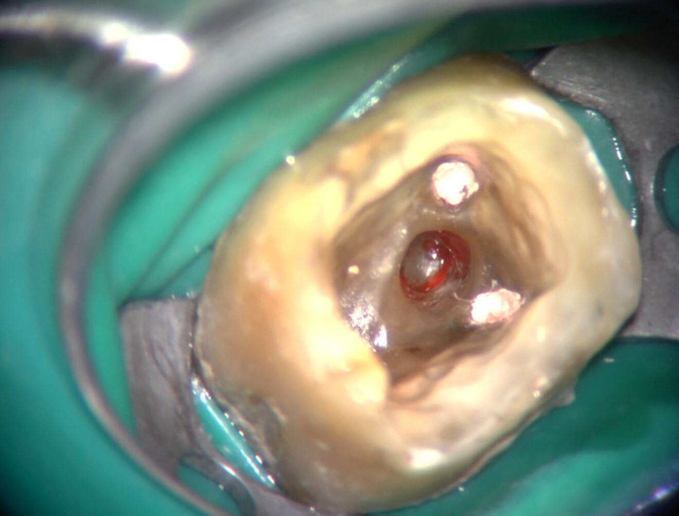 Fig. 25 : Isolation d’une perforation du plancher de la cavité sous microscope.