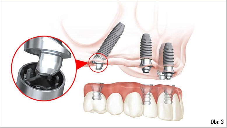 Nová funkce nacvaknutí u Multi-unit Abutment Plus pomůže ušetřit drahocenný čas při přeměně snímatelné náhrady na fixní provizorní náhradu – jedná se o běžnou součást koncepce ošetření All-on-4®