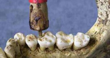 Un jet pour remplacer la fraise du dentiste