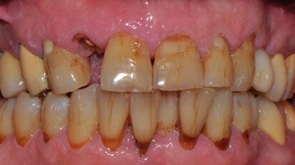 Impianti post-estrattivi immediati nei settori estetici: l’importanza della selezione del caso tramite un esame CBCT ad alta risoluzione