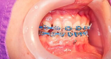 Tandartsen doen zich onterecht voor als orthodontist