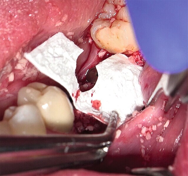 Fig. 31 : Mise en place d’une membrane de collagène à titre de barrière de protection et suture. 