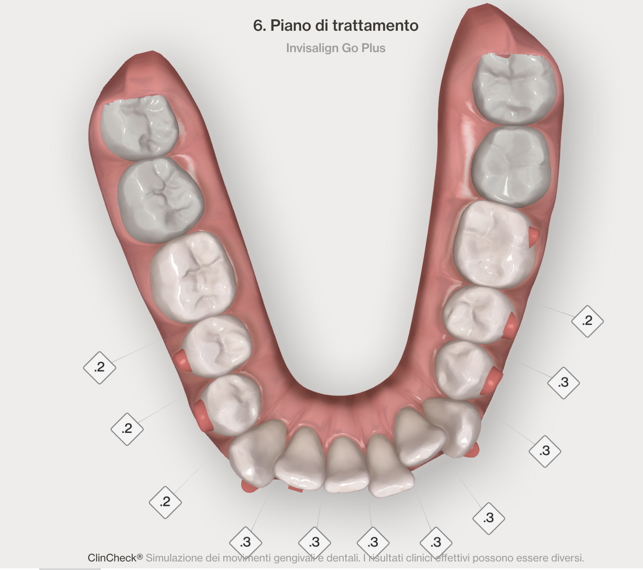 Figg. 4–7 - Pianificazione digitale nelle due arcate prima (Figg. 4, 5) e dopo (Figg. 6, 7). I numeri nel quadrato indicano la riduzione interprossimale pianificata.