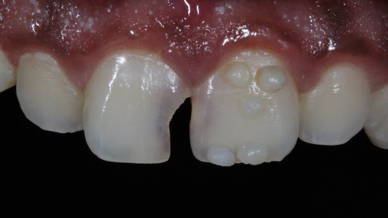 Fig 4: Shade Evaluation : Button technique (Hue)
