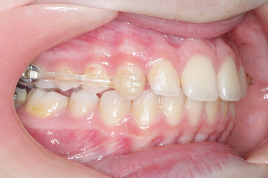 Fig. 12: Accomplishment of a Class I platform after three months of Motion. Case ready to scan and submit to Reveal.