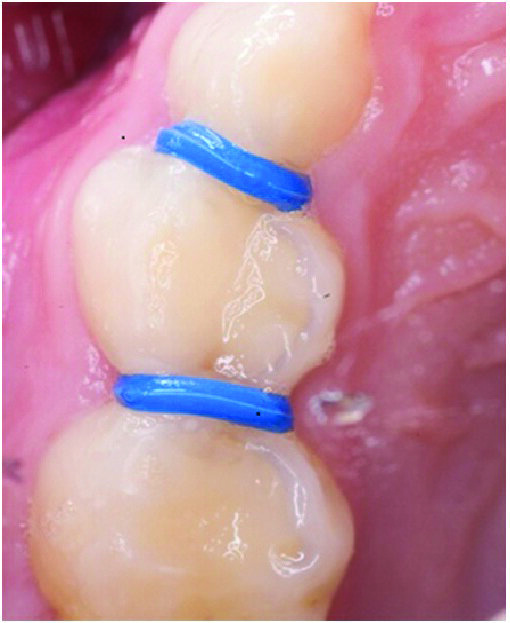 Figure 5: The Hall Technique: tooth 54 (distal caries shadow obvious) with orthodontic separators mesially and distally. They are left in situ for 3-5 days