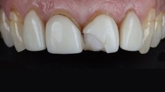 Glass-ceramic veneer cementation: Full adhesive workflow with PANAVIA Veneer LC