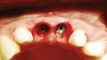 Predictable implant uncovery with diode laser