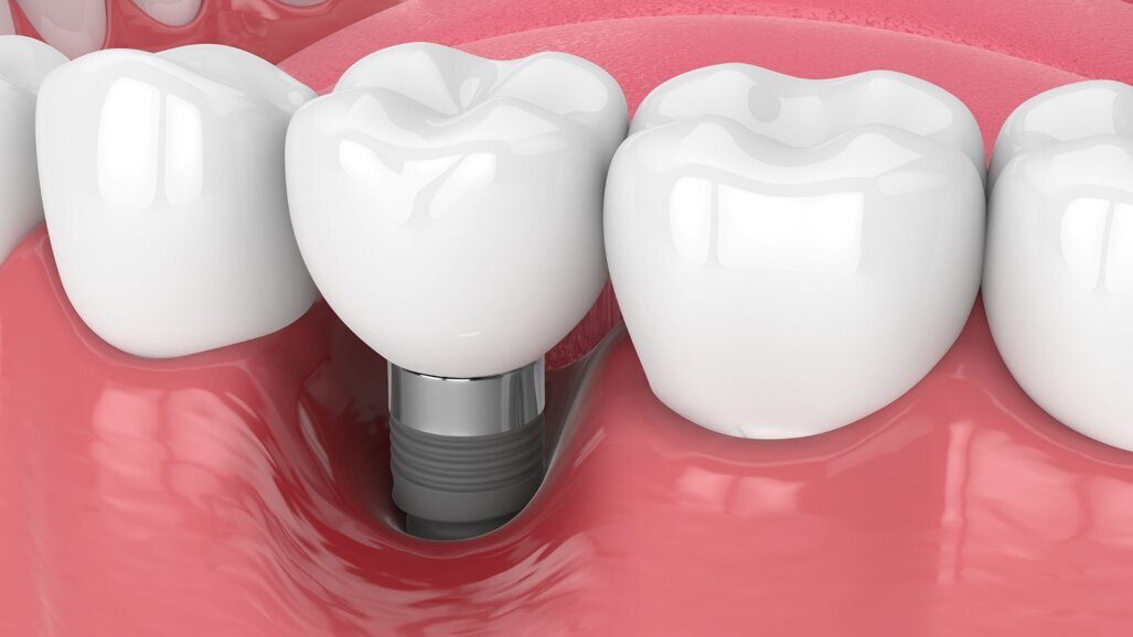 New research: understanding periodontal & peri-implant soft tissues better