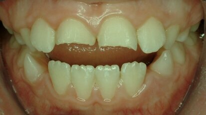 שכיחות חבלות בשיניים בעולם