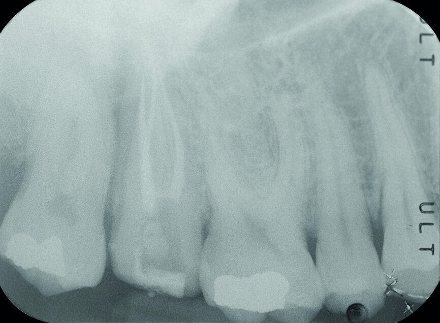 Fig. 3: Pre-op periapical radiograph.