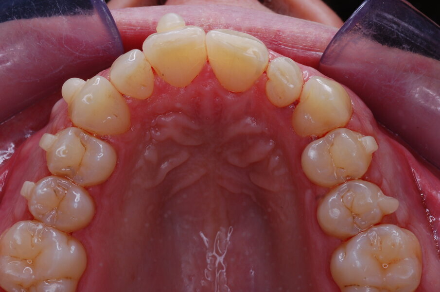 Figg. 25-29_Progressi clinici dopo 12 mesi di trattamento con allineatori.