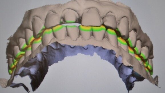 Zastosowanie skanera wewnątrzustnego w praktyce dentystycznej