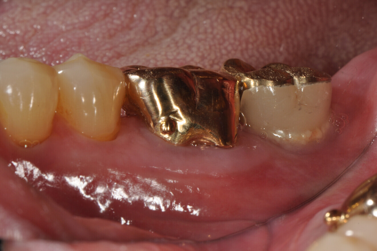 Plaque observed during subgingival probing on #47I.