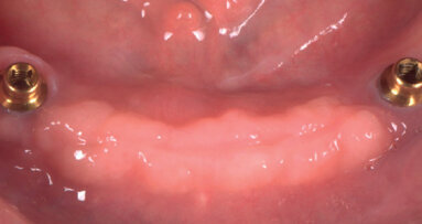 Riabilitazione superiore a supporto osteo-mucoso contrapposta a overdenture ritenuta e sostenuta da impianti