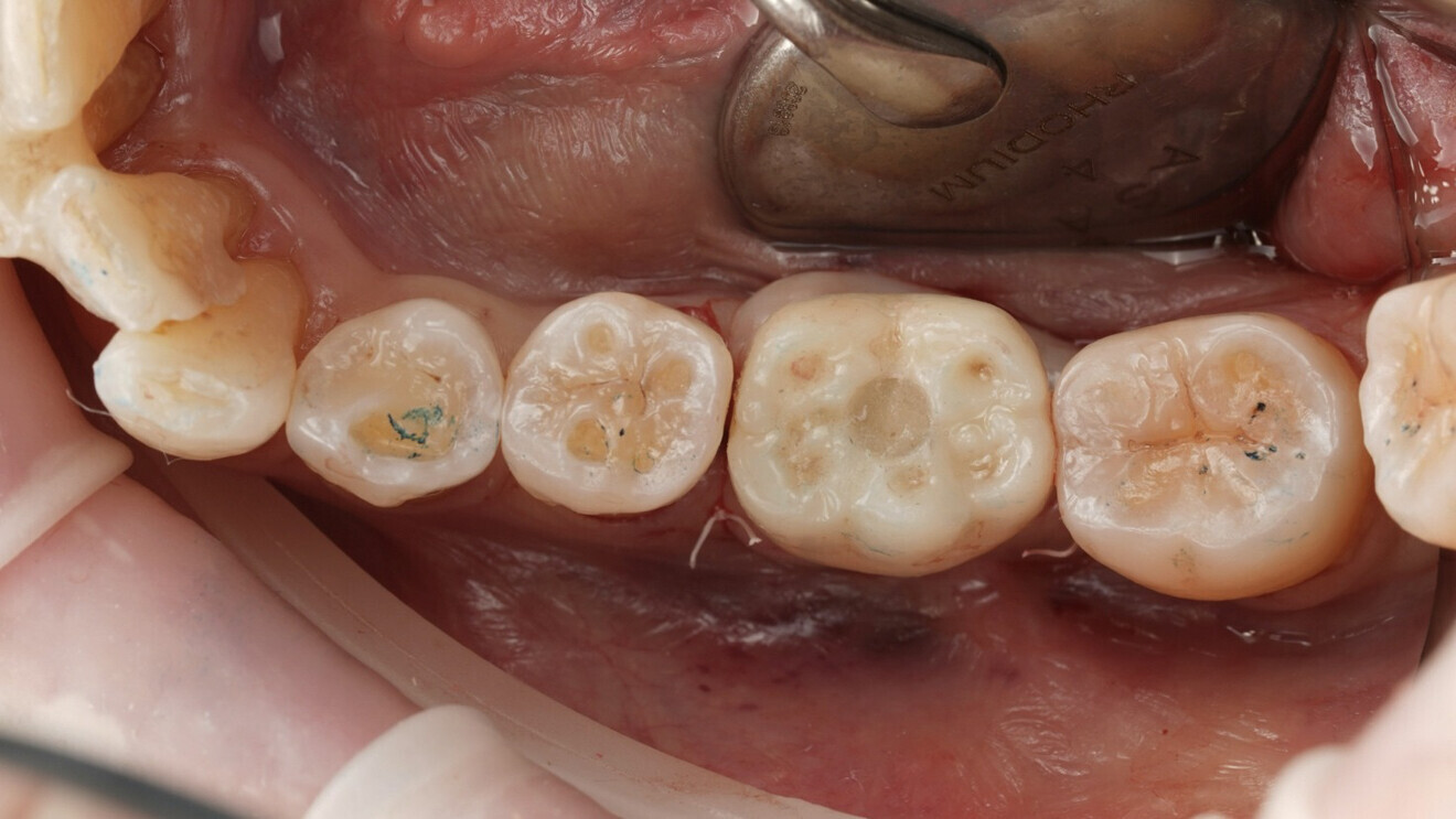 Fig. 14: Screw access hole sealed with PTFE tape and composite resin.