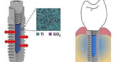 Nieuw implantaat gaat infecties tegen