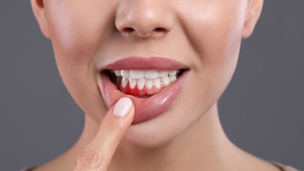 Gingivitis: Wie Mundgesundheit den Körper beeinflusst