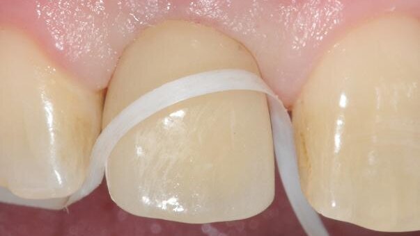 Maintenance of dental implants for the hygienist