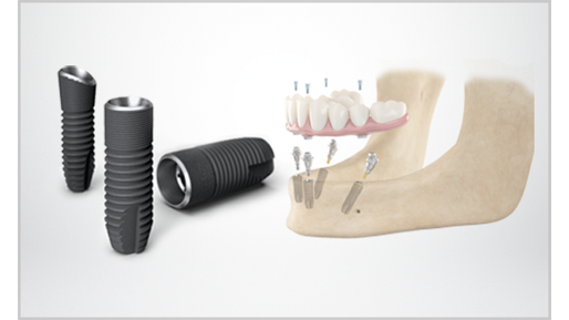 SmartFix concept - fixed restorations